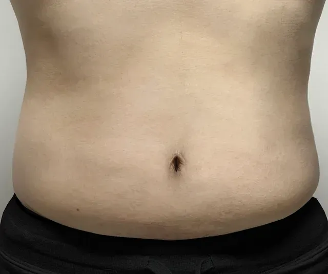 다이어트 한약, 형인재 감량비책 치료 후