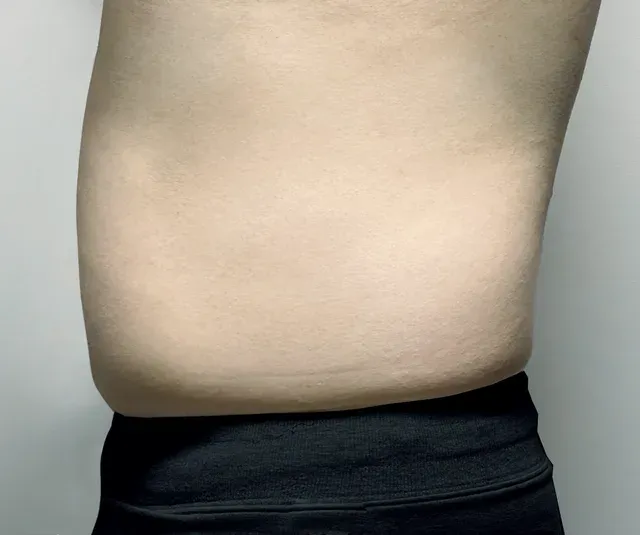다이어트 한약, 형인재 감량비책 치료 후