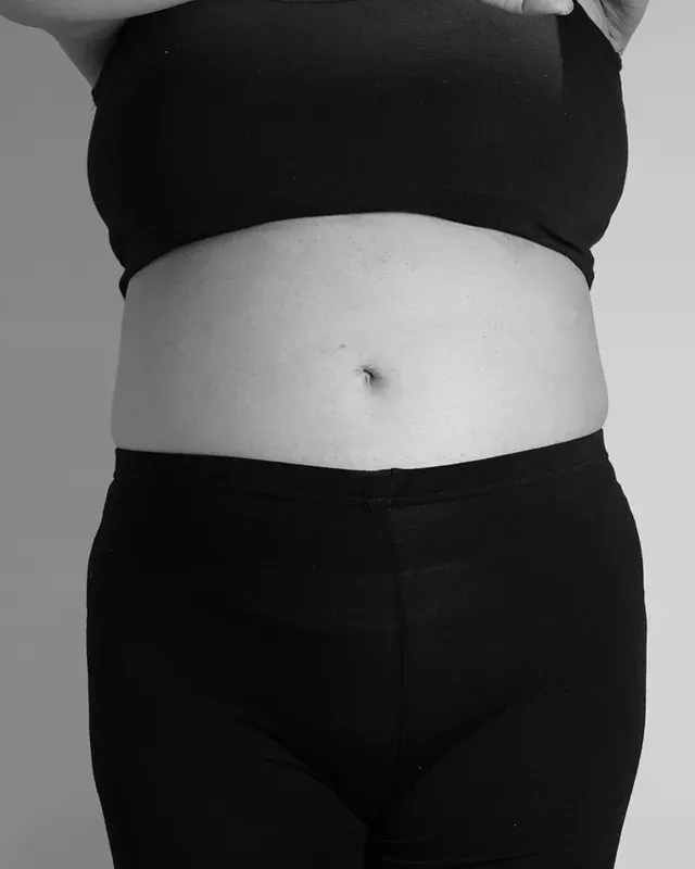 다이어트 한약, 형인재 감량비책 치료 전