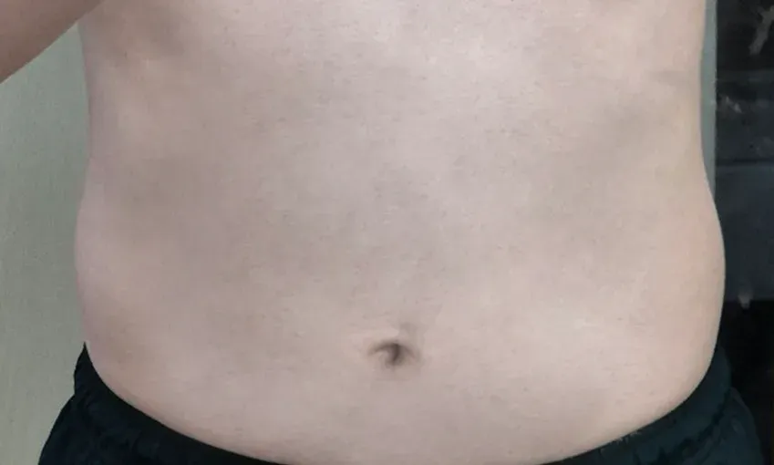 다이어트 한약, 형인재 감량비책 치료 후