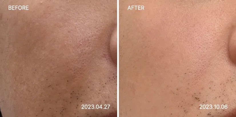 엑소좀 스킨부스터, 캐비어 리빌더 스킨부스터 치료 후