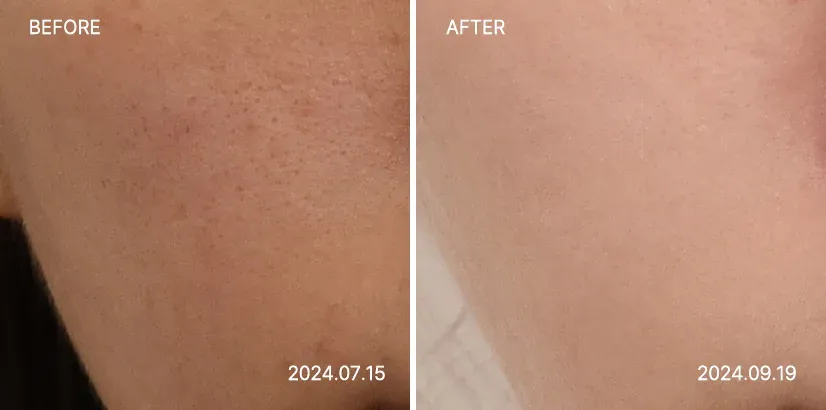 엑소좀 스킨부스터, 캐비어 리빌더 스킨부스터 치료 후